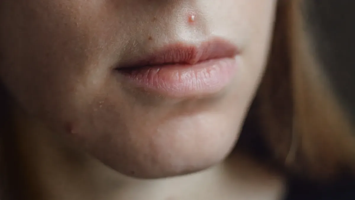 Cicatrizes de Acne: Estratégias Regenerativas para Pele Premium