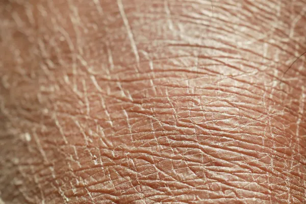 Melasma: Por Que Volta e o Que Realmente Controla a Mancha