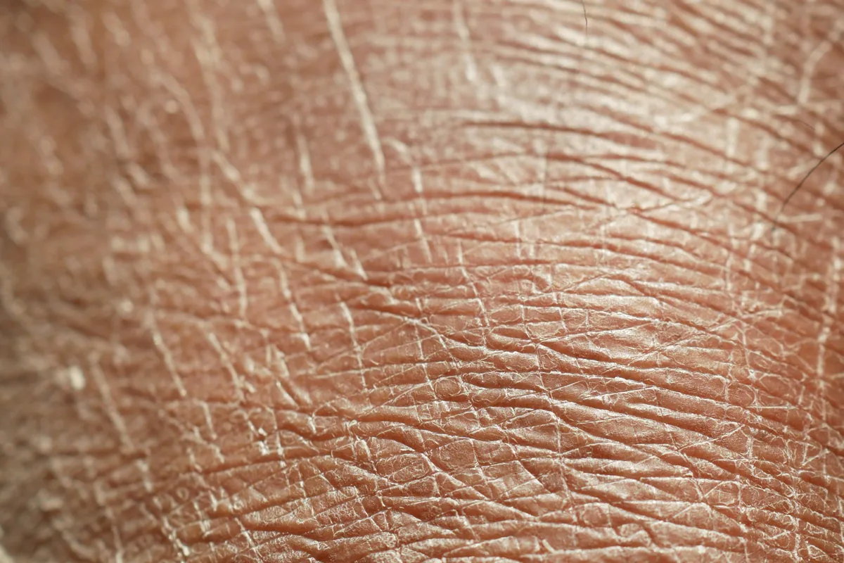 Melasma: Por Que Volta e o Que Realmente Controla a Mancha